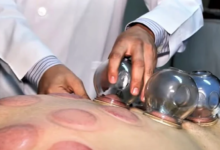 تاريخ الحجامة عبر الحضارات القديمة
