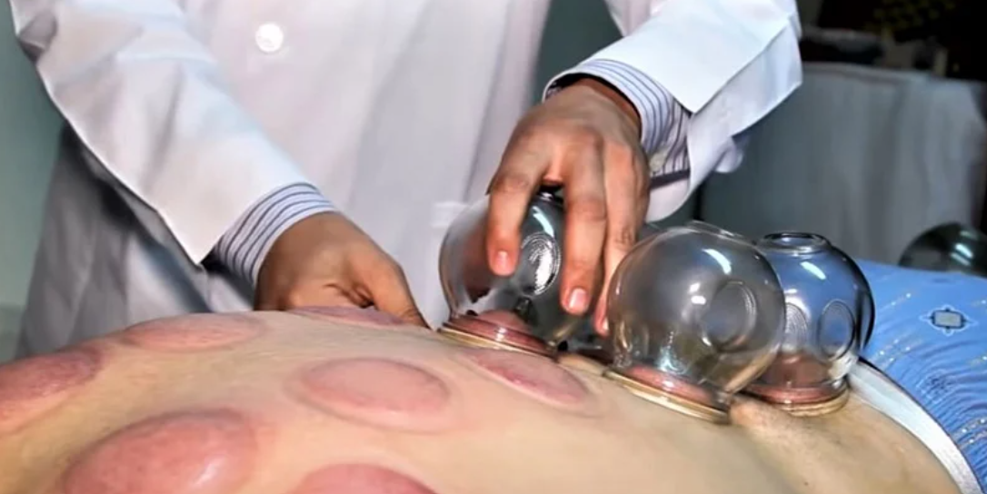 تاريخ الحجامة عبر الحضارات القديمة