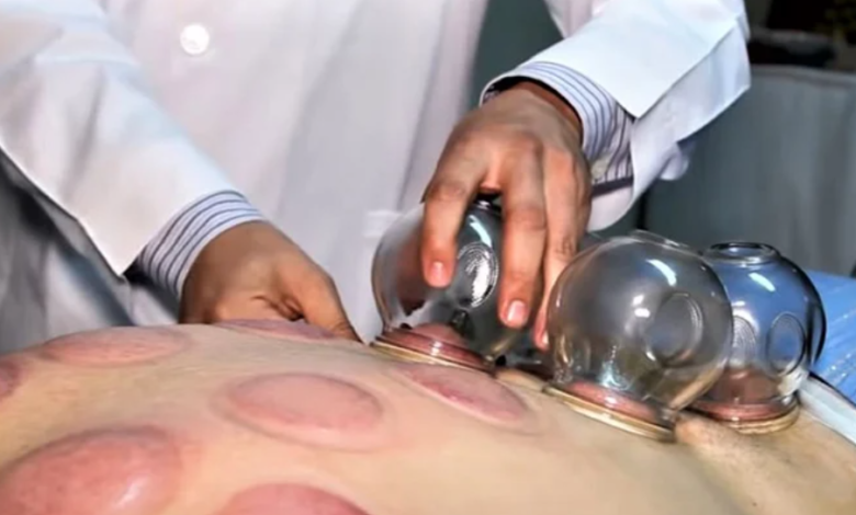 فوائد الحجامة وأبرز استخداماتها الشائعة فوائد الحجامة وأبرز استخداماتها الشائعة